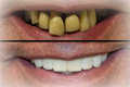 Immediate complete denture