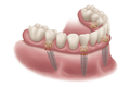 fixed complete denture