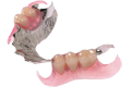 metallic partial denture